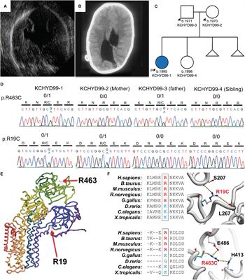 Recessive Inheritance of Congenital Hydrocephalus With Other Structural Brain Abnormalities Caused by Compound Heterozygous Mutations in ATP1A3